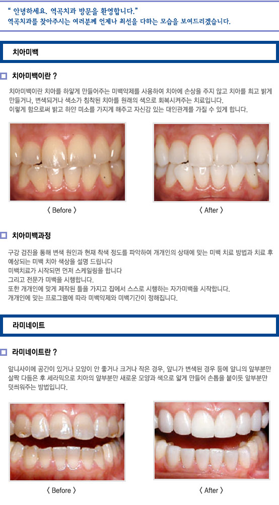치아미백/라미네이트